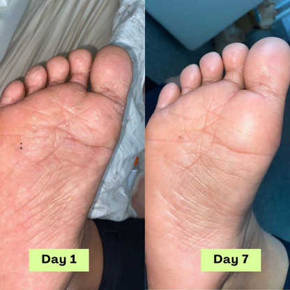 The Athlete’s Foot Recovery Bundle