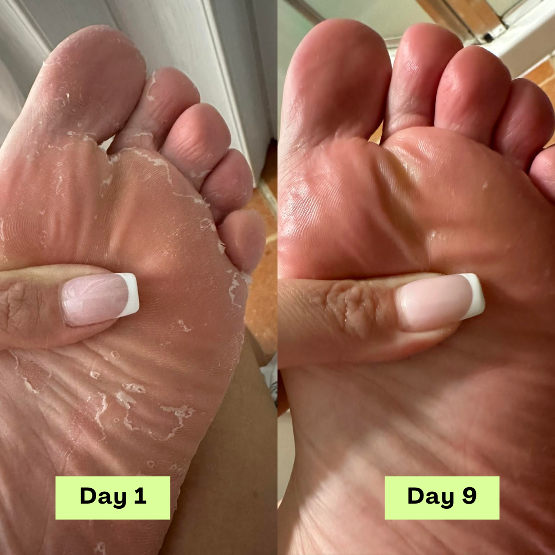 Beline® AntiFungal Relief Soap Bar