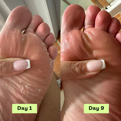 Beline® AntiFungal Relief Soap Bar