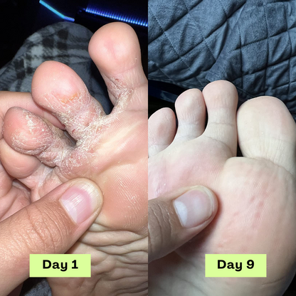 The Athlete’s Foot Recovery Bundle