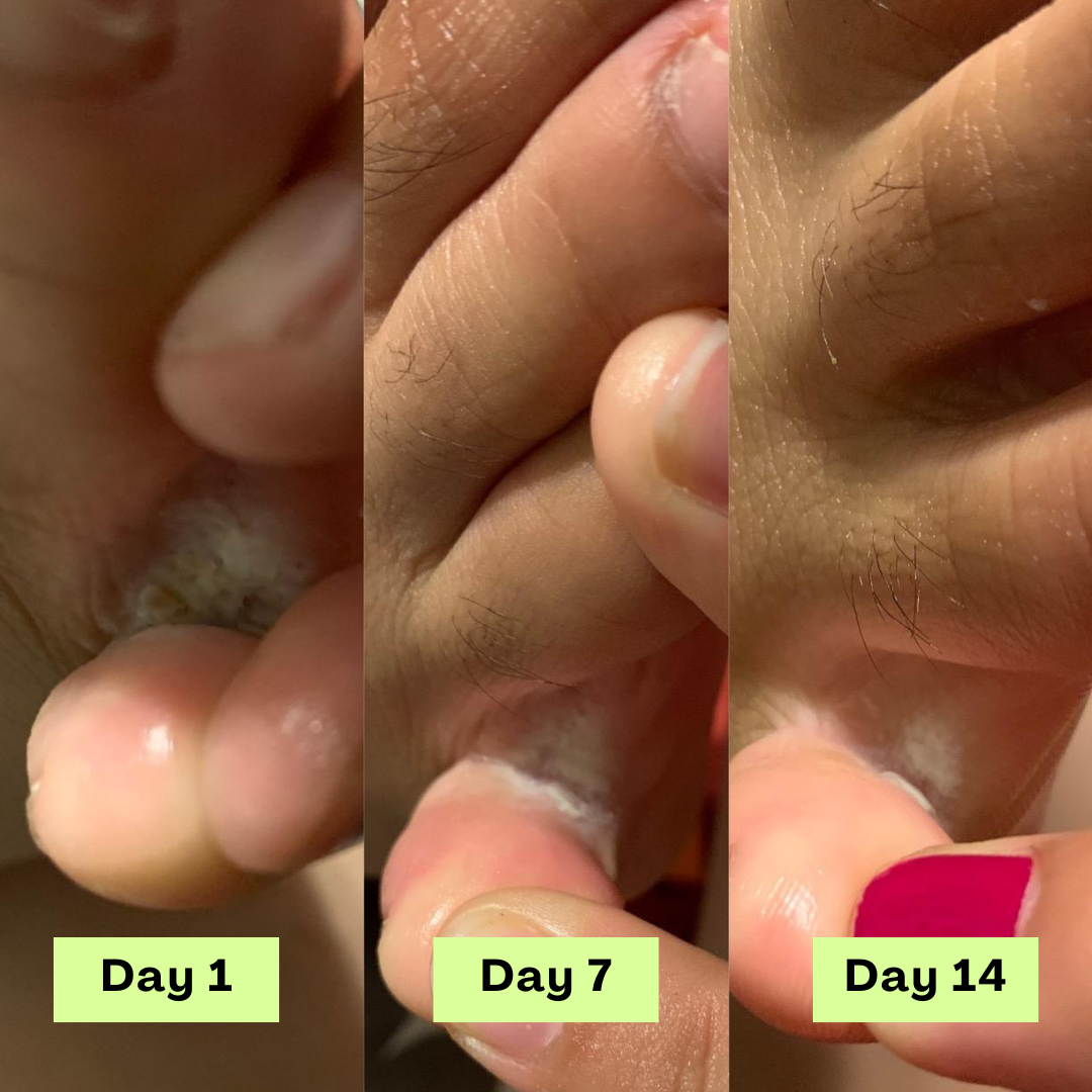 The Athlete’s Foot Recovery Bundle