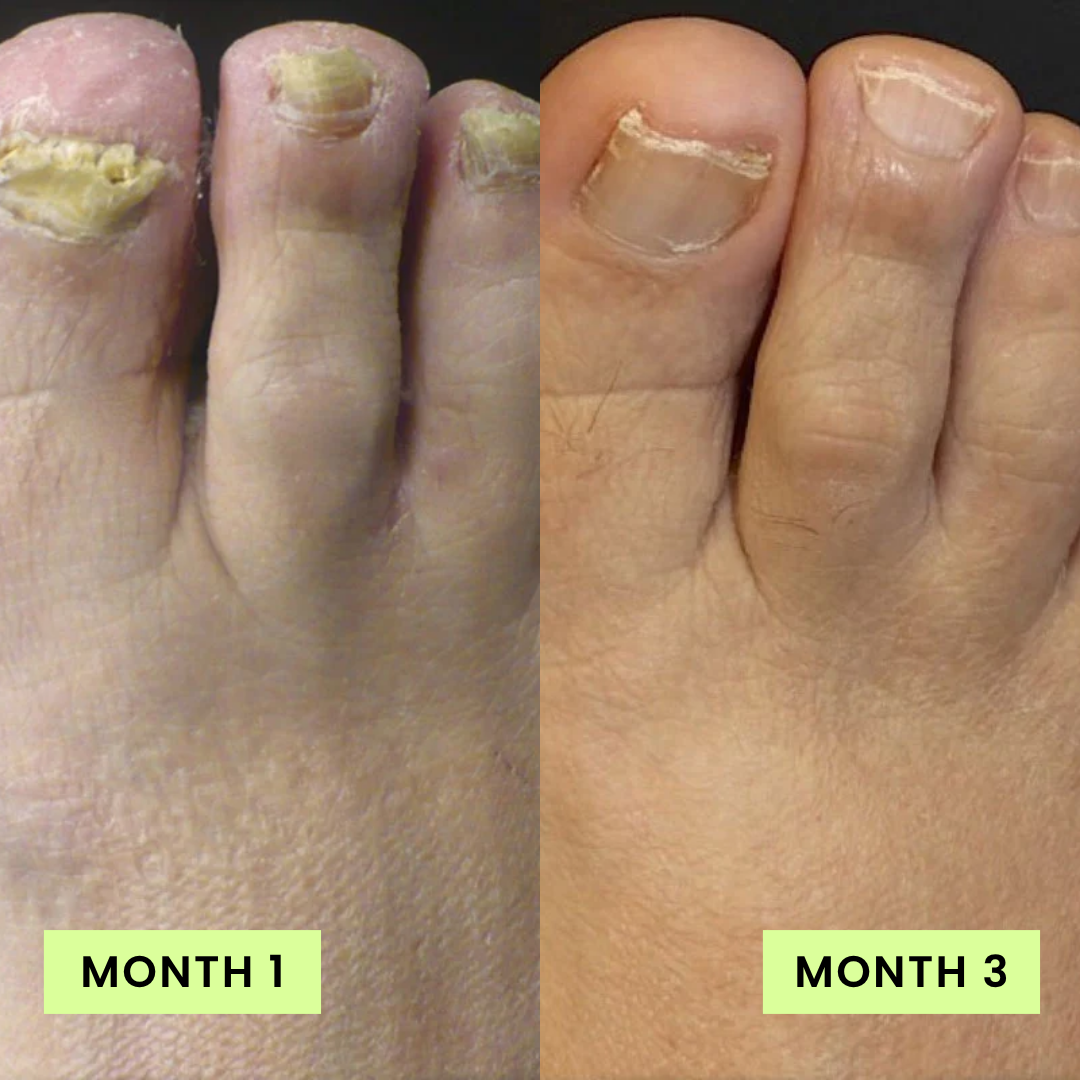 Beline Nail Care Pen - 25% Undecylenic Acid