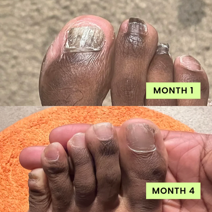 Beline Nail Care Pen - 25% Undecylenic Acid